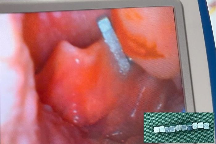 Các bác sĩ đã tiến hành nội soi và gắp chuỗi nam châm từ họng cháu bé.