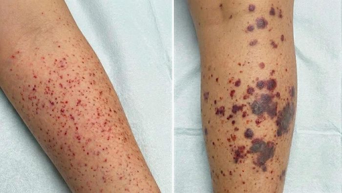 Ban xuất huyết sẫm màu, có dấu hiệu hoại tử trên da có thể cảnh báo nhiễm khuẩn huyết nặng do não mô cầu. Ảnh: BVCC.