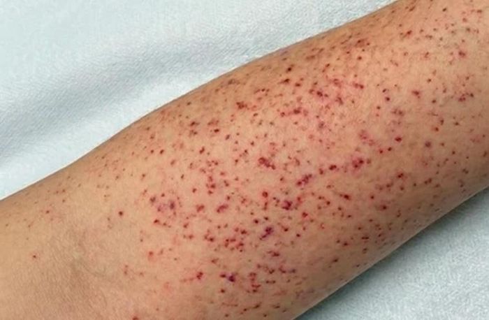 Những nốt ban sẫm màu, xuất huyết trên da là dấu hiệu cảnh báo người dân không nên bỏ qua. Ảnh: BVCC.