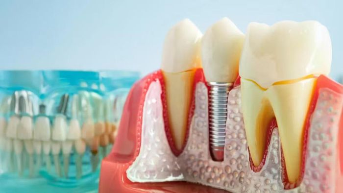 Một số người ghép răng Implants bị viêm nhiễm nhưng không thể điều trị bằng kháng sinh.