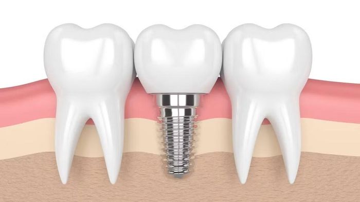Vệ sinh răng Implant cần đúng phương pháp.