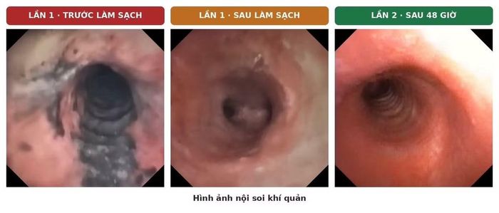 Tổn thương phế quản trên nội soi - Ảnh BVCC
