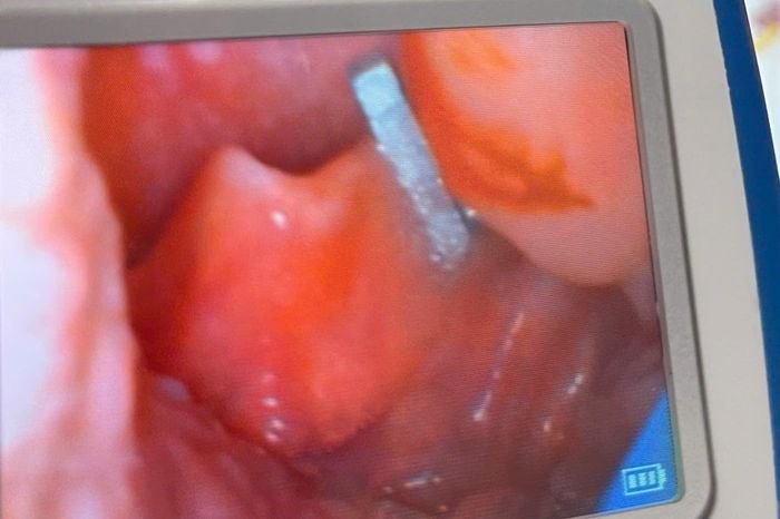 Hình ảnh qua nội soi chuỗi nam châm từ đồ chơi xếp hình đã được các bác sĩ Bệnh viện Nhi Hải Phòng gắp thành công