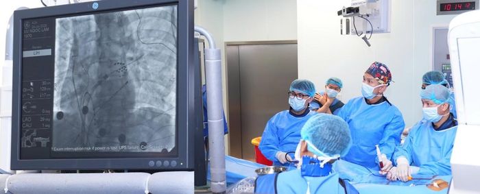 PFA là một trong những công nghệ điều trị rối loạn nhịp tim hiện đại nhất hiện nay. Ảnh: Bệnh viện Trung ương Quân đội 108
