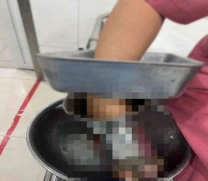 Bàn tay phải của nữ nhân viên bất ngờ bị cuốn vào máy xay thịt. Ảnh: BV cung cấp