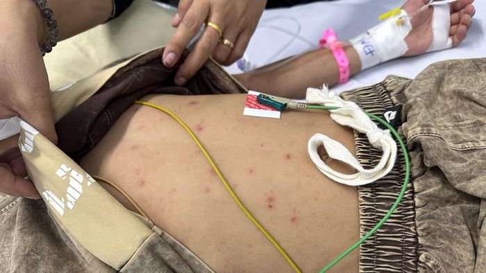 Ban xuất huyết dưới da là dấu hiệu cảnh báo nguy hiểm ở người mắc não mô cầu. Ảnh: Bệnh viện Nhi đồng 2 (TP.HCM).