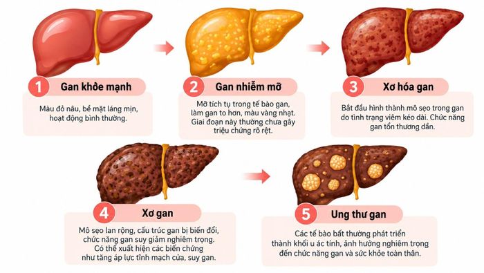  Các giai đoạn tổn thương gan. Đồ họa: P.Mai. 