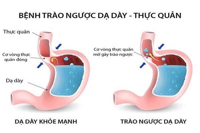 Bệnh trào ngược dạ dày - thực quản. Ảnh: Bác sĩ Nguyễn Thế Anh