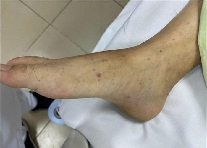  Ban xuất huyết ở bệnh nhân não mô cầu. Ảnh: BVCC. 
