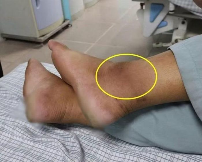 Hình ảnh vết cắn trên chân người bệnh - Ảnh BVCC