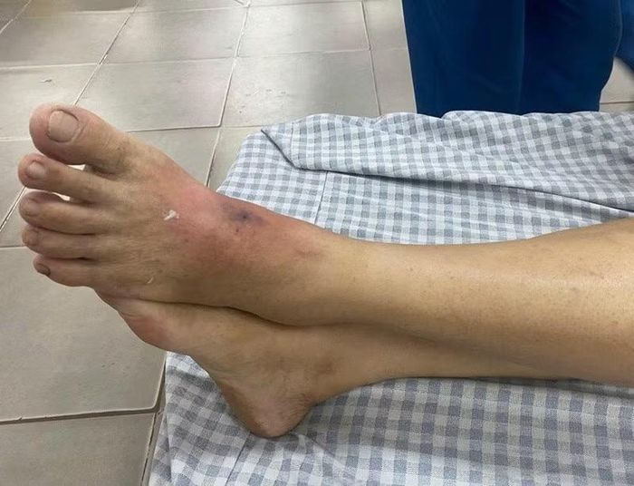 Hình ảnh vết cắn của người bệnh bị sưng nề, đau buốt - Ảnh BVCC