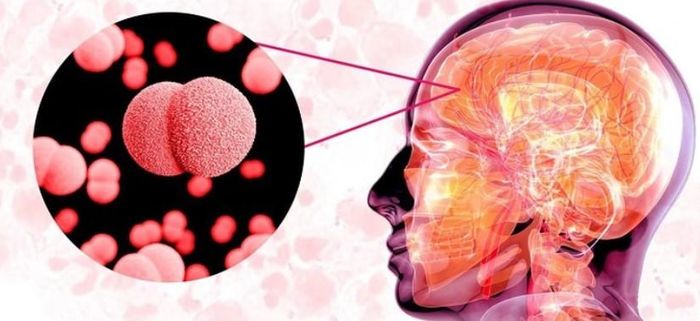 Viêm não do não mô cầu là một trong những bệnh truyền nhiễm nguy hiểm, có tốc độ tiến triển rất nhanh và nguy cơ tử vong cao nếu không được phát hiện, điều trị kịp thời. Ảnh minh họa