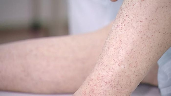 Sốt cao, đau đầu, mệt mỏi, buồn nôn, chán ăn, xuất huyết dưới da... là triệu chứng thường gặp của bệnh não mô cầu. (Ảnh: THÚY QUỲNH)