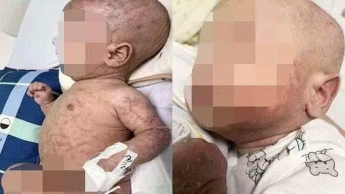 Bé N.M trước khi ghép tế bào gốc tạo máu.
