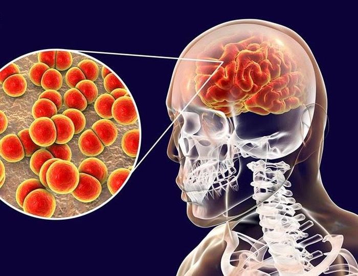 Bệnh não mô cầu là bệnh truyền nhiễm cấp tính nguy hiểm, lây truyền chủ yếu qua đường tiếp xúc trực tiếp qua đường hô hấp. Ảnh minh họa