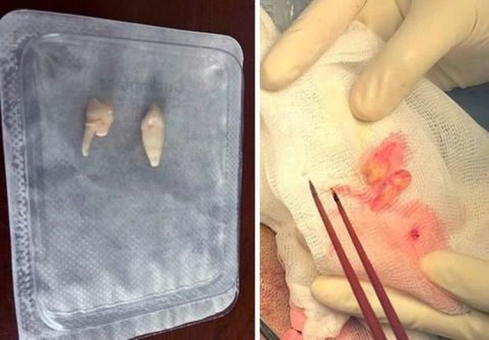 Dị vật được lấy ra khỏi hộp sọ